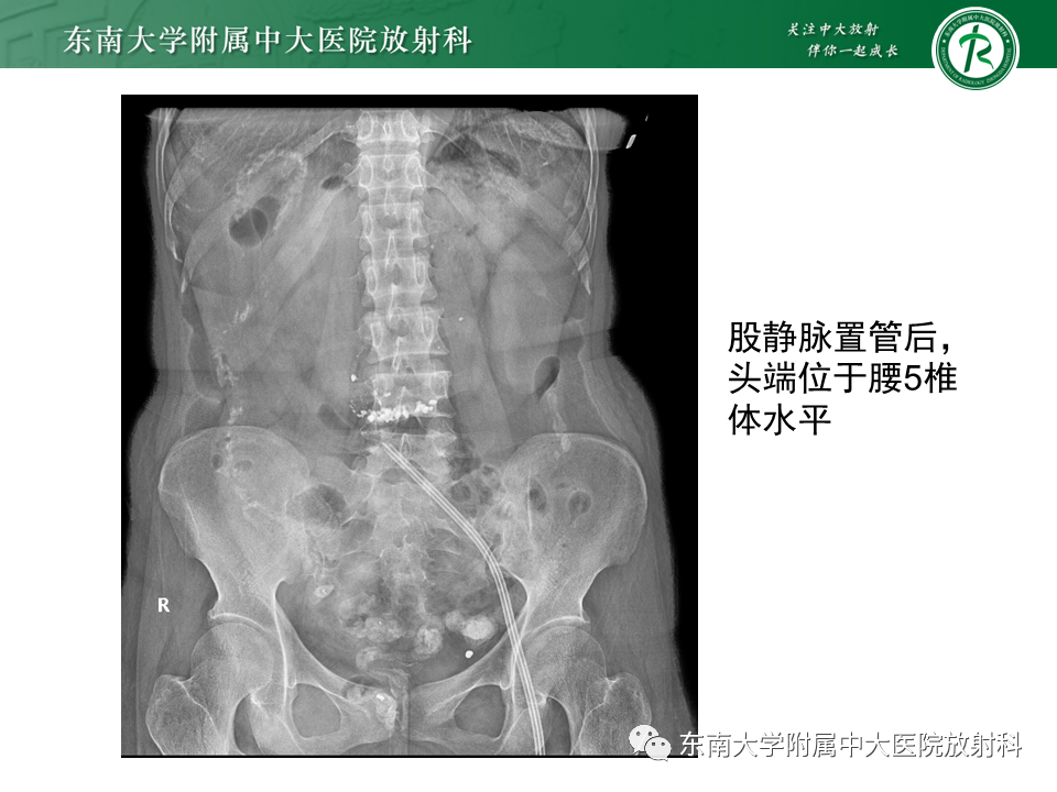 影像PPT - 【PPT】体内常见置管位置影像评估-32