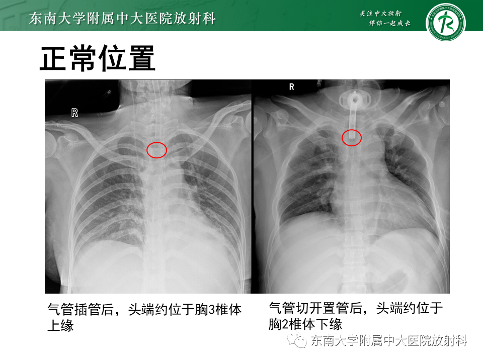 影像PPT - 【PPT】体内常见置管位置影像评估-37