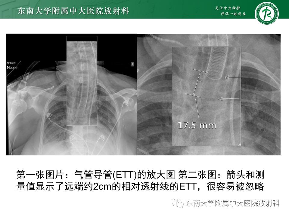 影像PPT - 【PPT】体内常见置管位置影像评估-39
