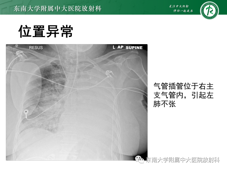 影像PPT - 【PPT】体内常见置管位置影像评估-40