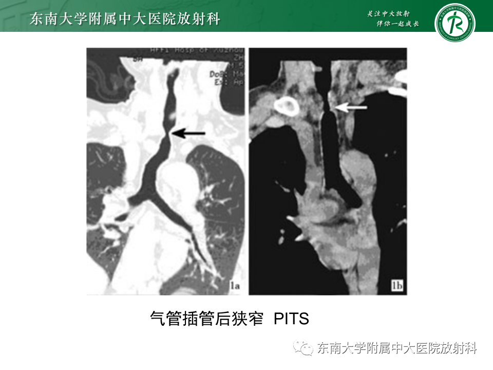 影像PPT - 【PPT】体内常见置管位置影像评估-41