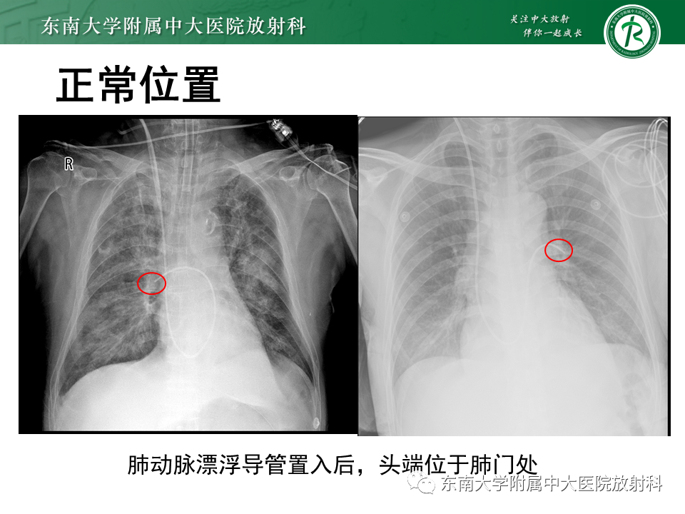 影像PPT - 【PPT】体内常见置管位置影像评估-44