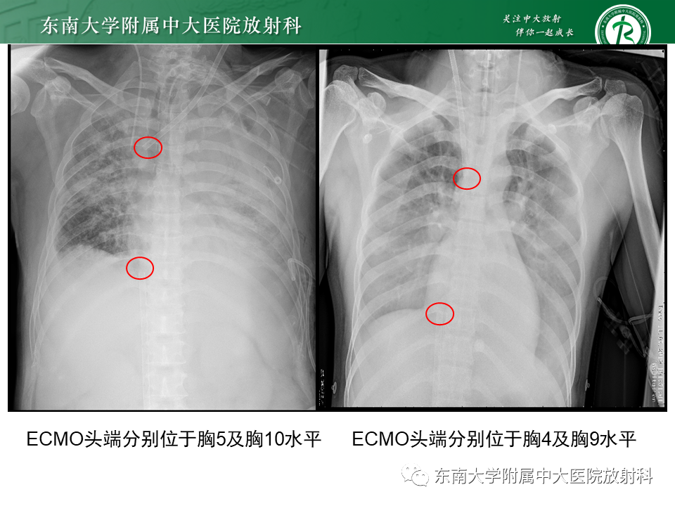 影像PPT - 【PPT】体内常见置管位置影像评估-48