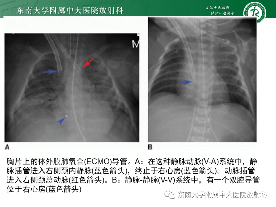 影像PPT - 【PPT】体内常见置管位置影像评估-49