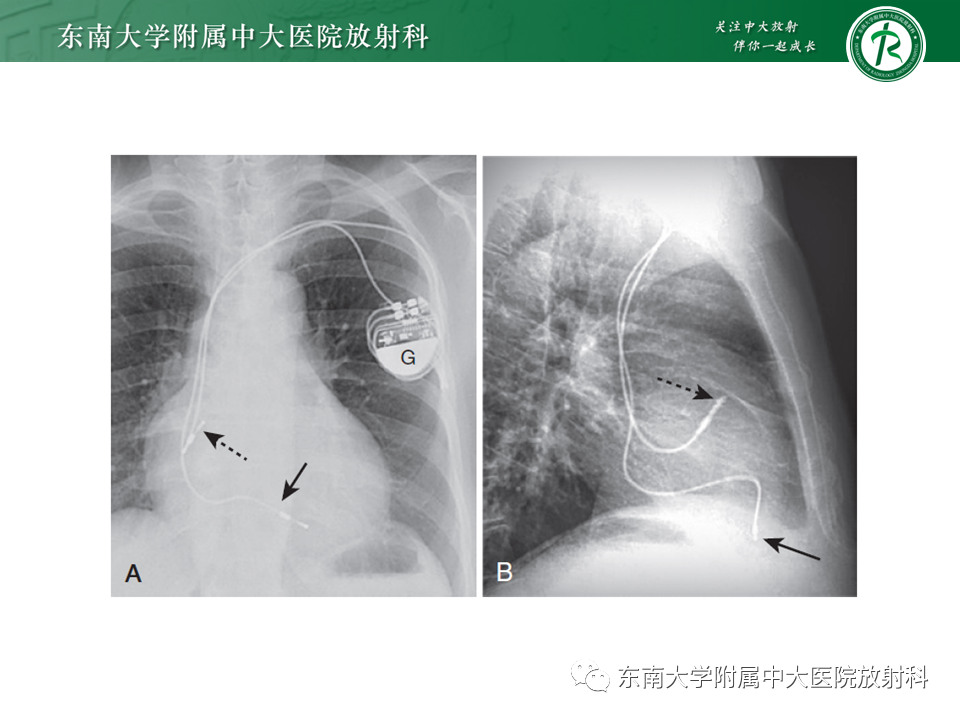 影像PPT - 【PPT】体内常见置管位置影像评估-51