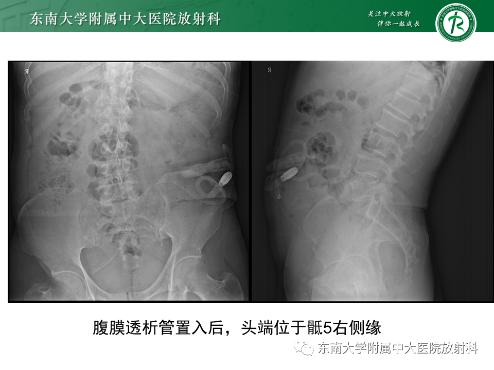 影像PPT - 【PPT】体内常见置管位置影像评估-54