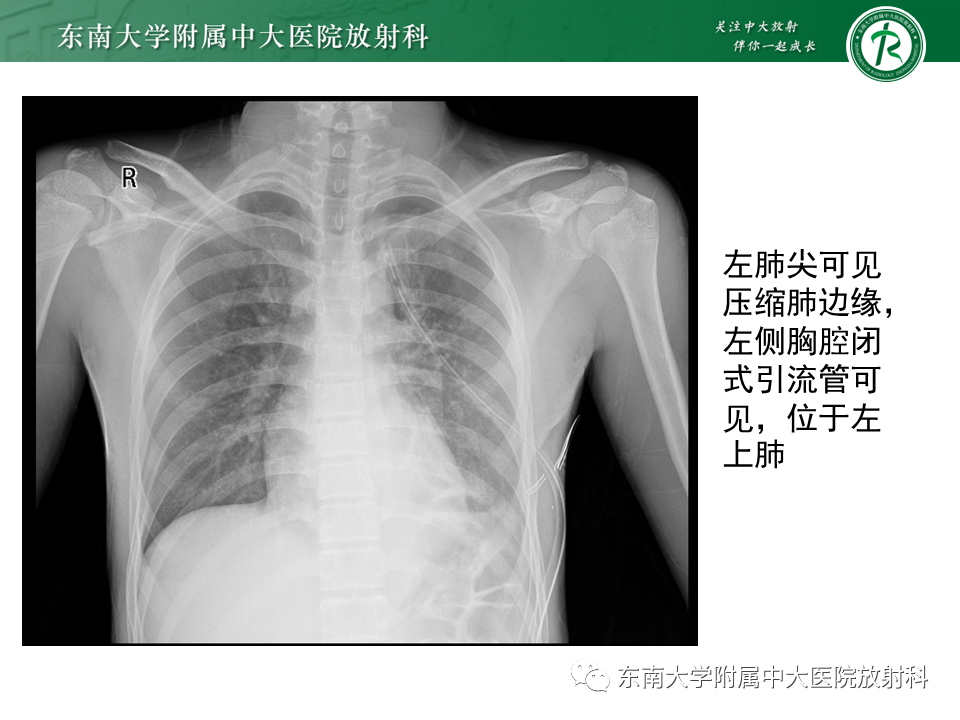 影像PPT - 【PPT】体内常见置管位置影像评估-56