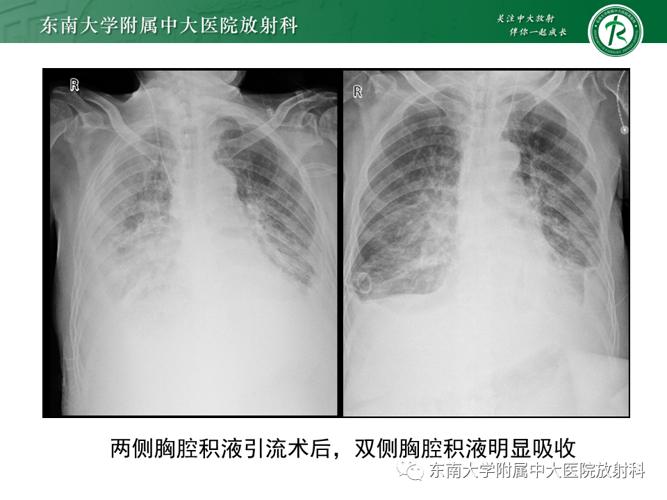 影像PPT - 【PPT】体内常见置管位置影像评估-57