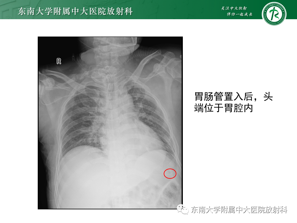 影像PPT - 【PPT】体内常见置管位置影像评估-59