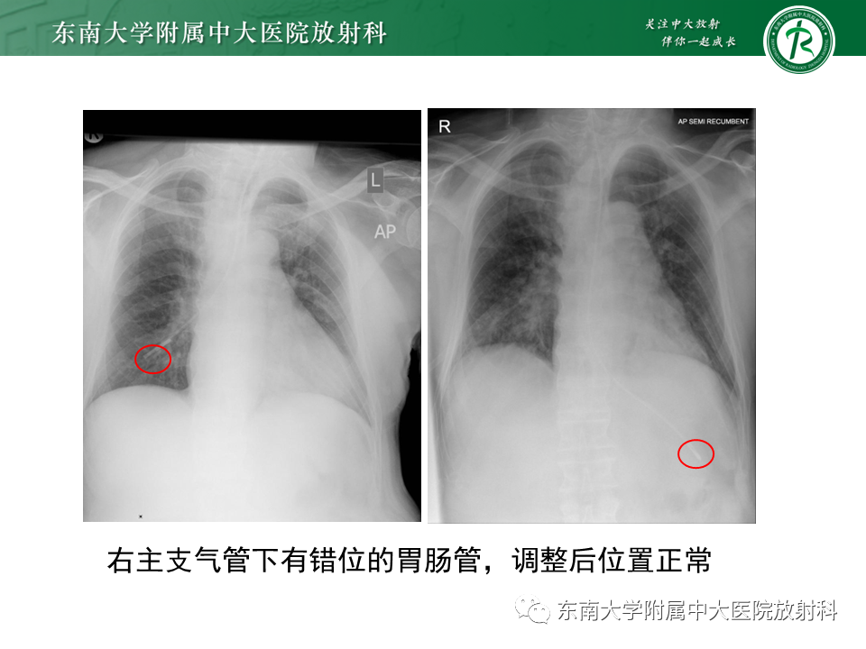 影像PPT - 【PPT】体内常见置管位置影像评估-60
