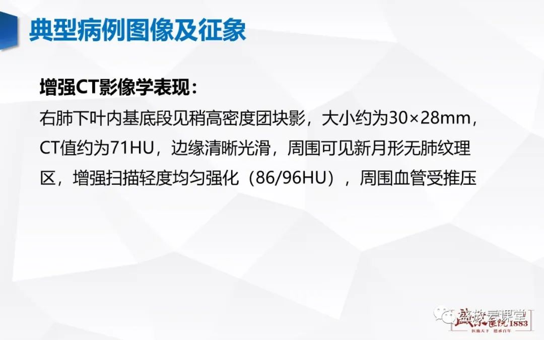 影像PPT - 【病例】硬化性肺细胞瘤1例CT影像-4