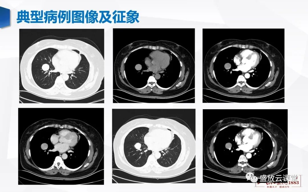 影像PPT - 【病例】硬化性肺细胞瘤1例CT影像-3