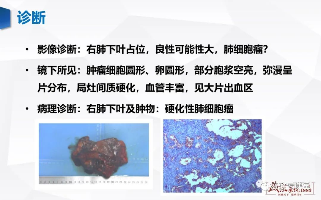影像PPT - 【病例】硬化性肺细胞瘤1例CT影像-7