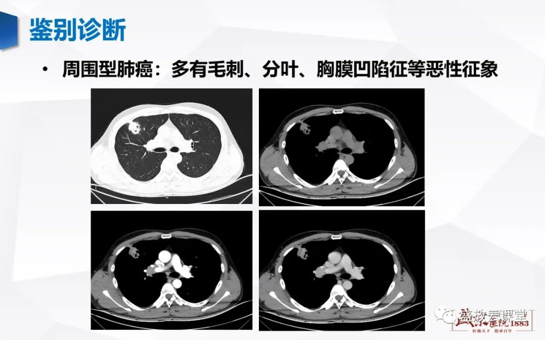 影像PPT - 【病例】硬化性肺细胞瘤1例CT影像-8