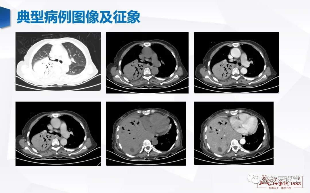 影像PPT - 【病例】肺淋巴瘤(MALT)一例CT影像-2