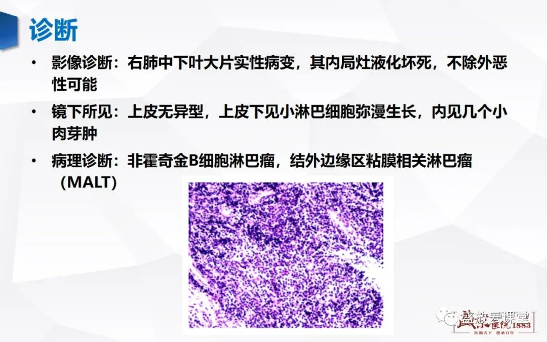 影像PPT - 【病例】肺淋巴瘤(MALT)一例CT影像-6