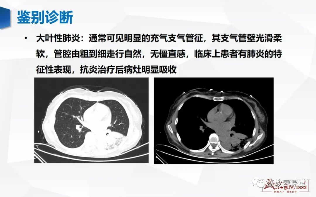 影像PPT - 【病例】肺淋巴瘤(MALT)一例CT影像-7