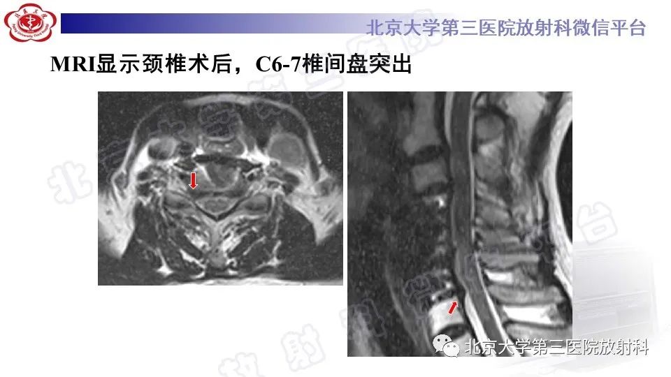 影像PPT - 【PPT】CT引导下介入技术在脊柱退行性疾病诊疗中的应用-4