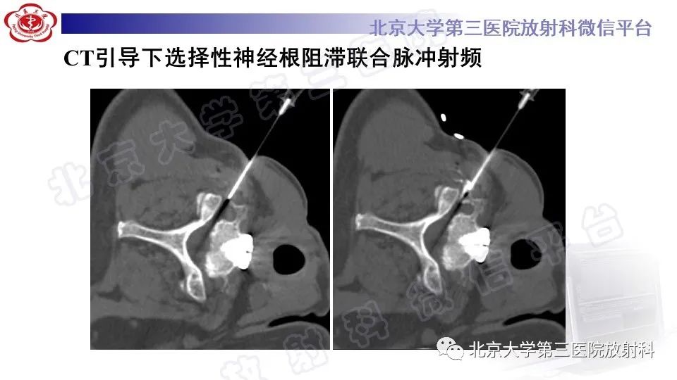 影像PPT - 【PPT】CT引导下介入技术在脊柱退行性疾病诊疗中的应用-6
