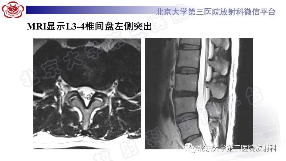 影像PPT - 【PPT】CT引导下介入技术在脊柱退行性疾病诊疗中的应用-10