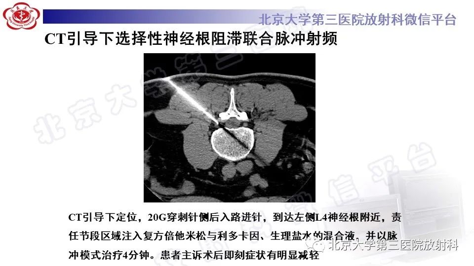 影像PPT - 【PPT】CT引导下介入技术在脊柱退行性疾病诊疗中的应用-12