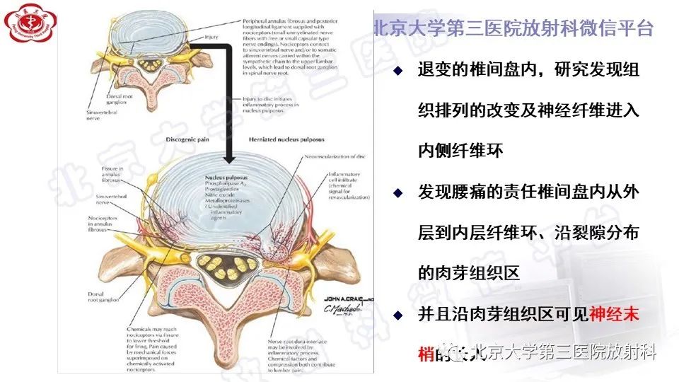 影像PPT - 【PPT】CT引导下介入技术在脊柱退行性疾病诊疗中的应用-23