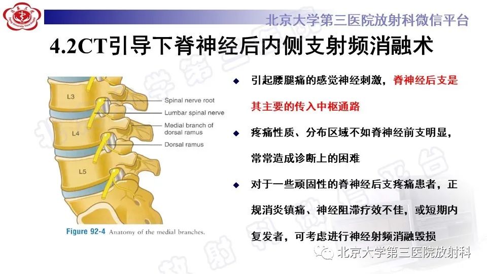 影像PPT - 【PPT】CT引导下介入技术在脊柱退行性疾病诊疗中的应用-28