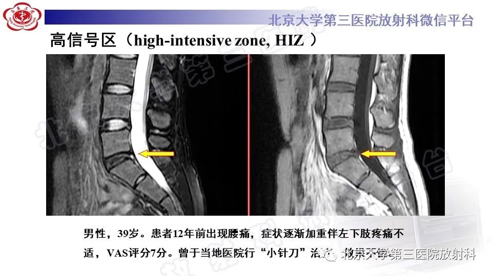 影像PPT - 【PPT】CT引导下介入技术在脊柱退行性疾病诊疗中的应用-30
