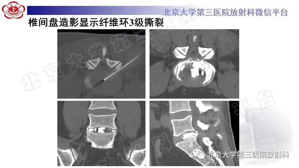 影像PPT - 【PPT】CT引导下介入技术在脊柱退行性疾病诊疗中的应用-31