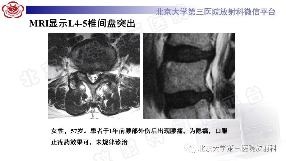 影像PPT - 【PPT】CT引导下介入技术在脊柱退行性疾病诊疗中的应用-32