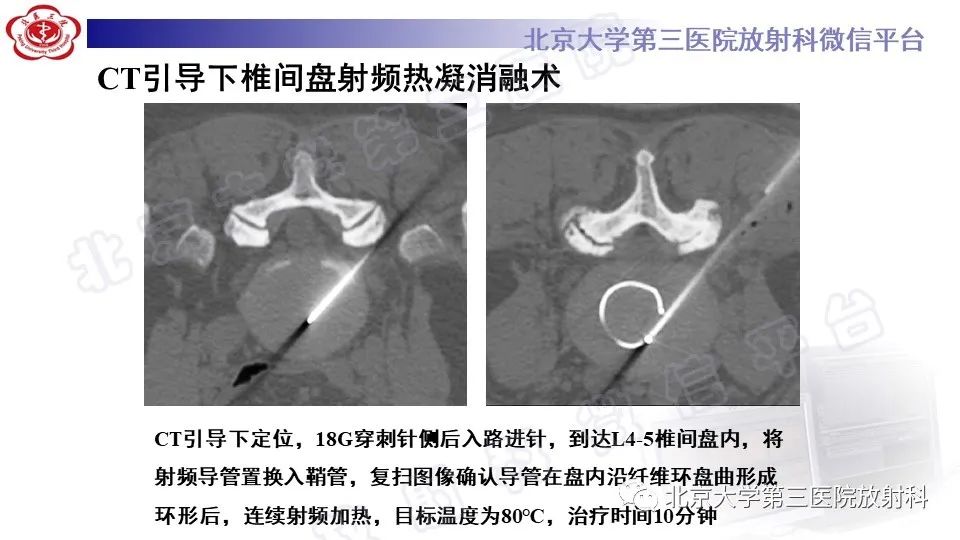 影像PPT - 【PPT】CT引导下介入技术在脊柱退行性疾病诊疗中的应用-33