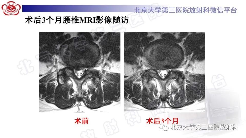 影像PPT - 【PPT】CT引导下介入技术在脊柱退行性疾病诊疗中的应用-34