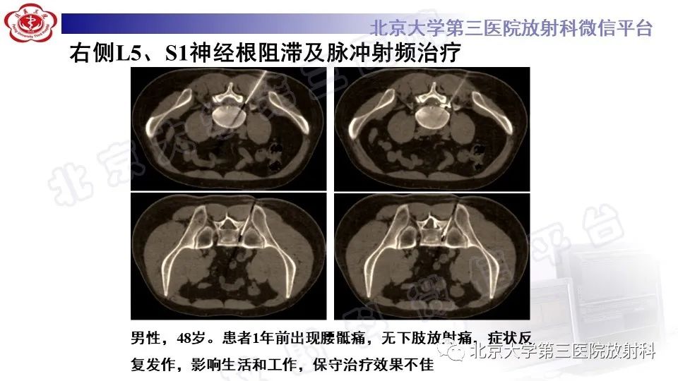 影像PPT - 【PPT】CT引导下介入技术在脊柱退行性疾病诊疗中的应用-35