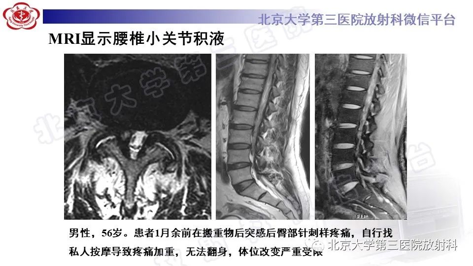 影像PPT - 【PPT】CT引导下介入技术在脊柱退行性疾病诊疗中的应用-36