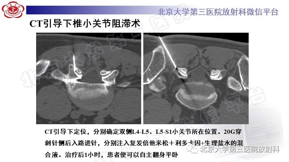 影像PPT - 【PPT】CT引导下介入技术在脊柱退行性疾病诊疗中的应用-37