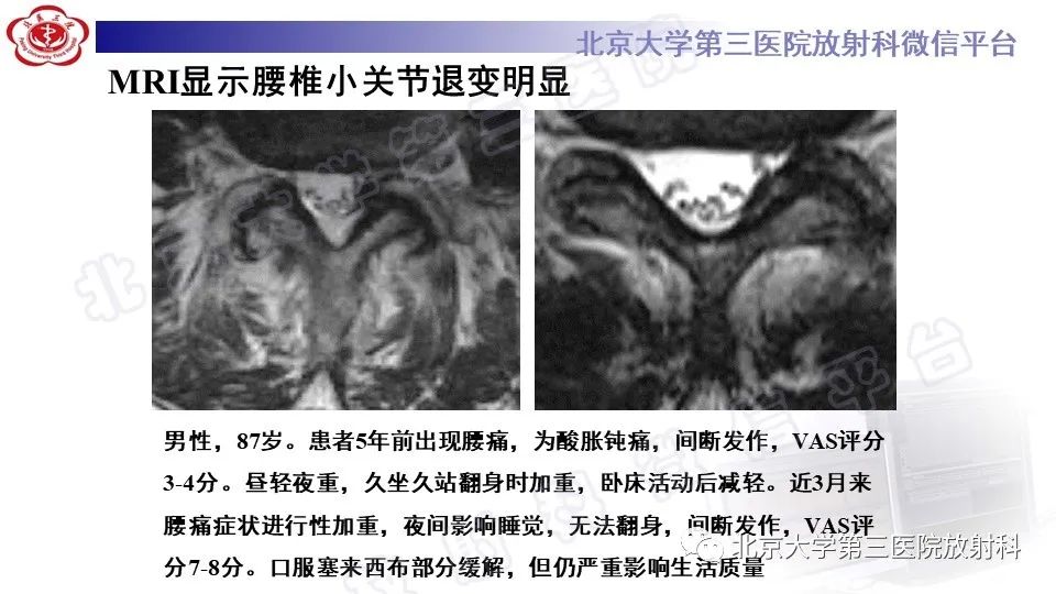 影像PPT - 【PPT】CT引导下介入技术在脊柱退行性疾病诊疗中的应用-38