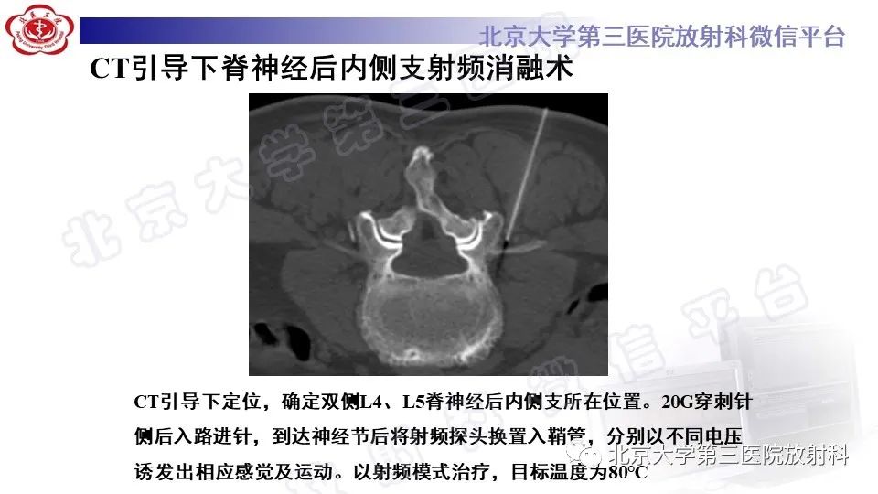 影像PPT - 【PPT】CT引导下介入技术在脊柱退行性疾病诊疗中的应用-39