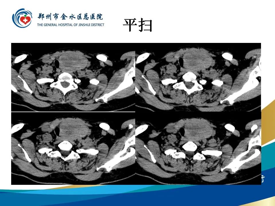 影像PPT - 【PPT】甲状腺常见相关疾病的影像诊断-5