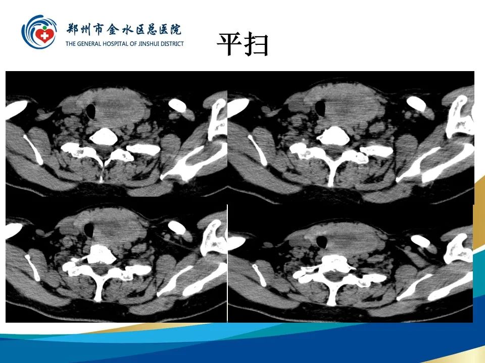 影像PPT - 【PPT】甲状腺常见相关疾病的影像诊断-6