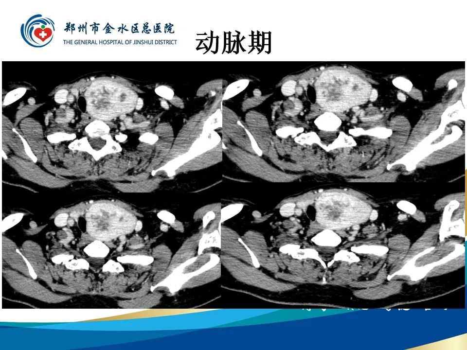 影像PPT - 【PPT】甲状腺常见相关疾病的影像诊断-7