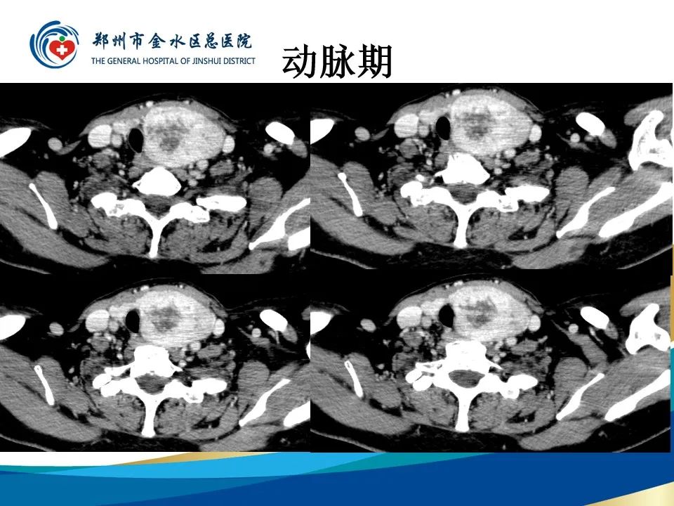 影像PPT - 【PPT】甲状腺常见相关疾病的影像诊断-8