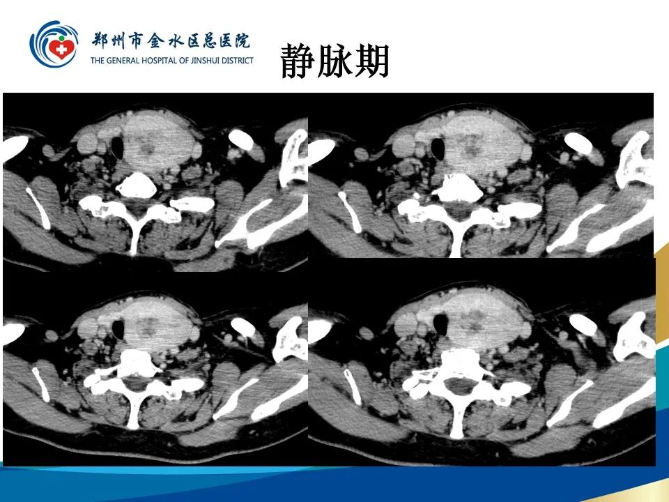影像PPT - 【PPT】甲状腺常见相关疾病的影像诊断-10