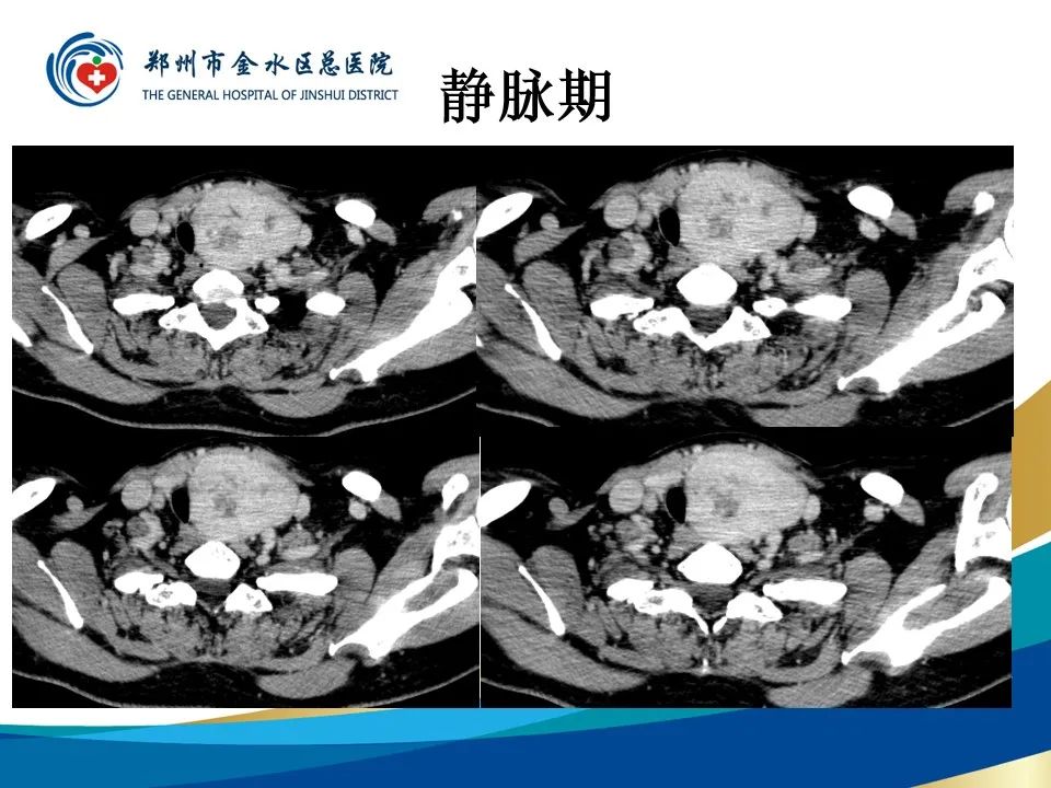 影像PPT - 【PPT】甲状腺常见相关疾病的影像诊断-9