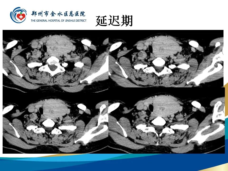影像PPT - 【PPT】甲状腺常见相关疾病的影像诊断-11