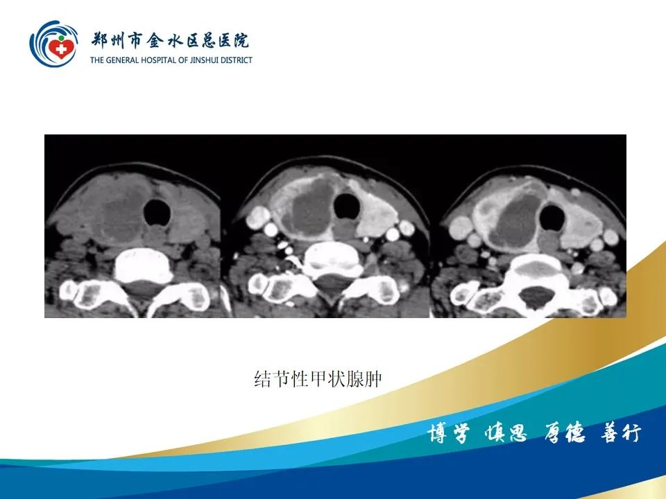 影像PPT - 【PPT】甲状腺常见相关疾病的影像诊断-25