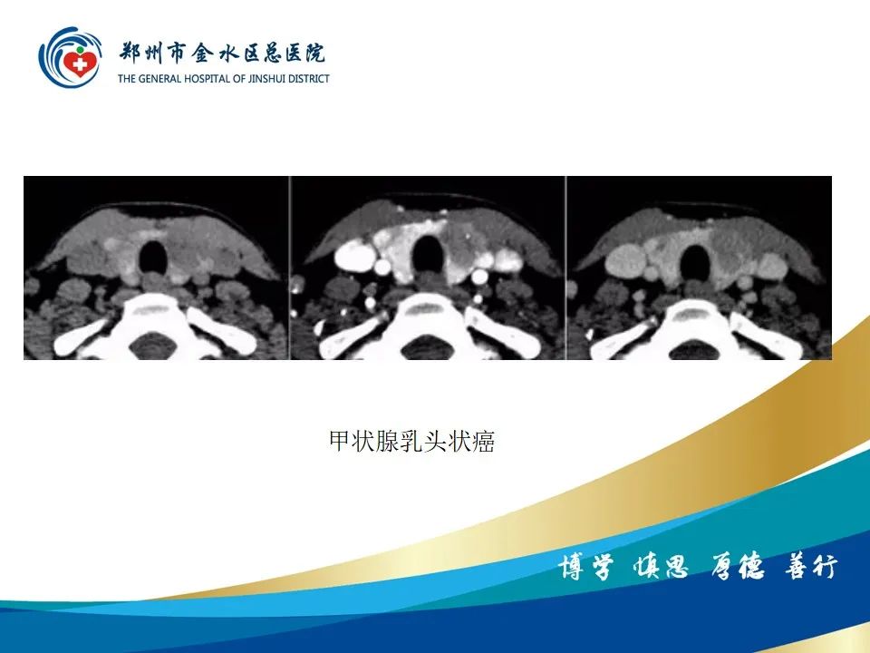 影像PPT - 【PPT】甲状腺常见相关疾病的影像诊断-29
