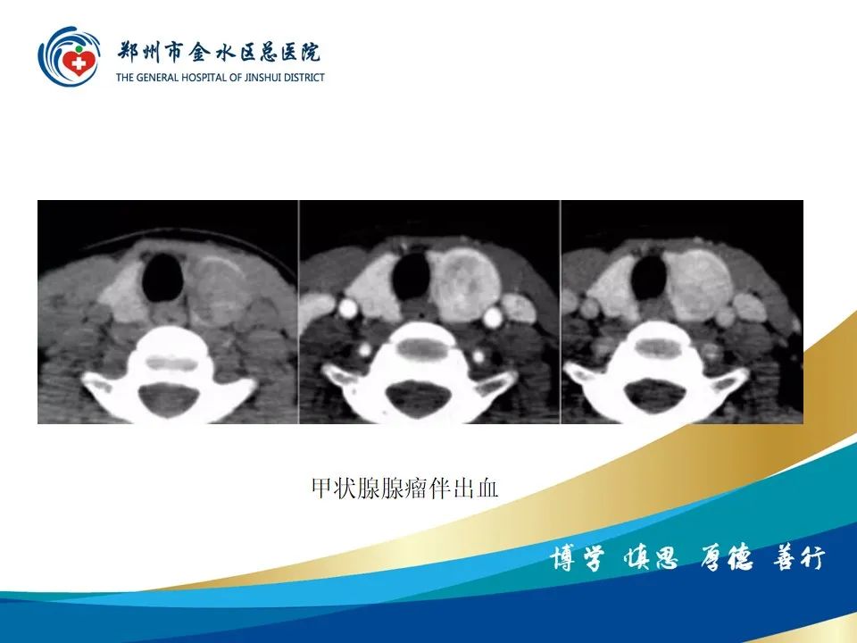 影像PPT - 【PPT】甲状腺常见相关疾病的影像诊断-27