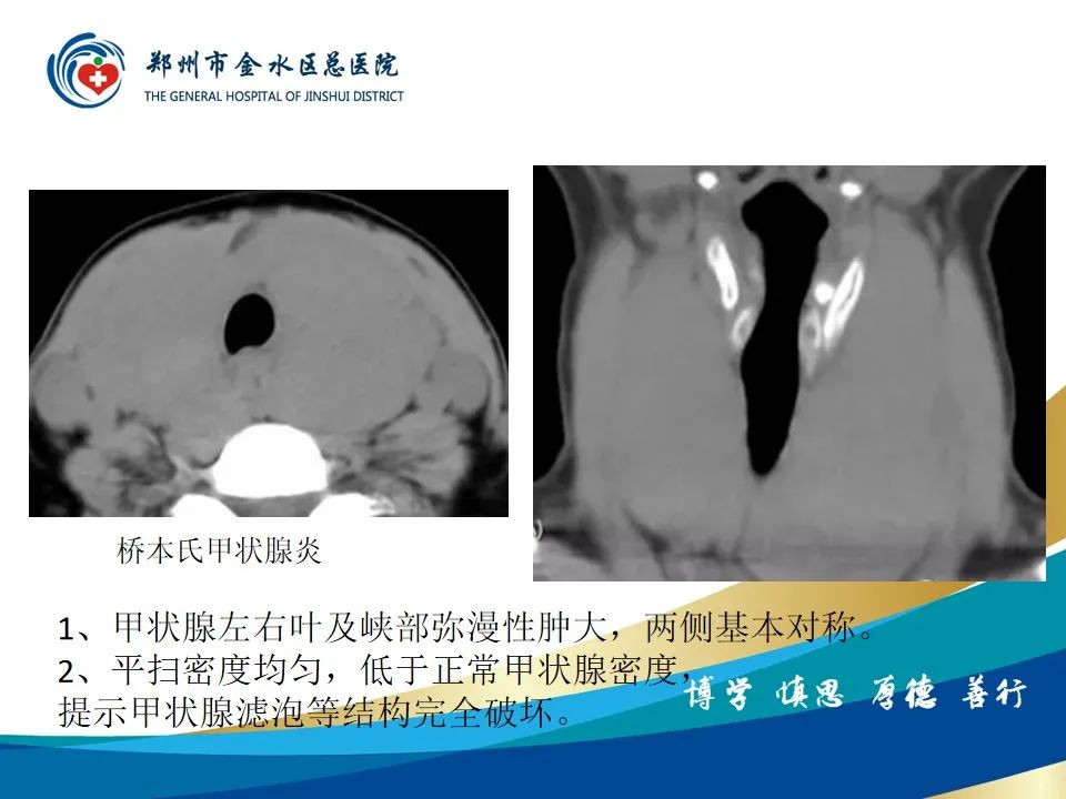 影像PPT - 【PPT】甲状腺常见相关疾病的影像诊断-32