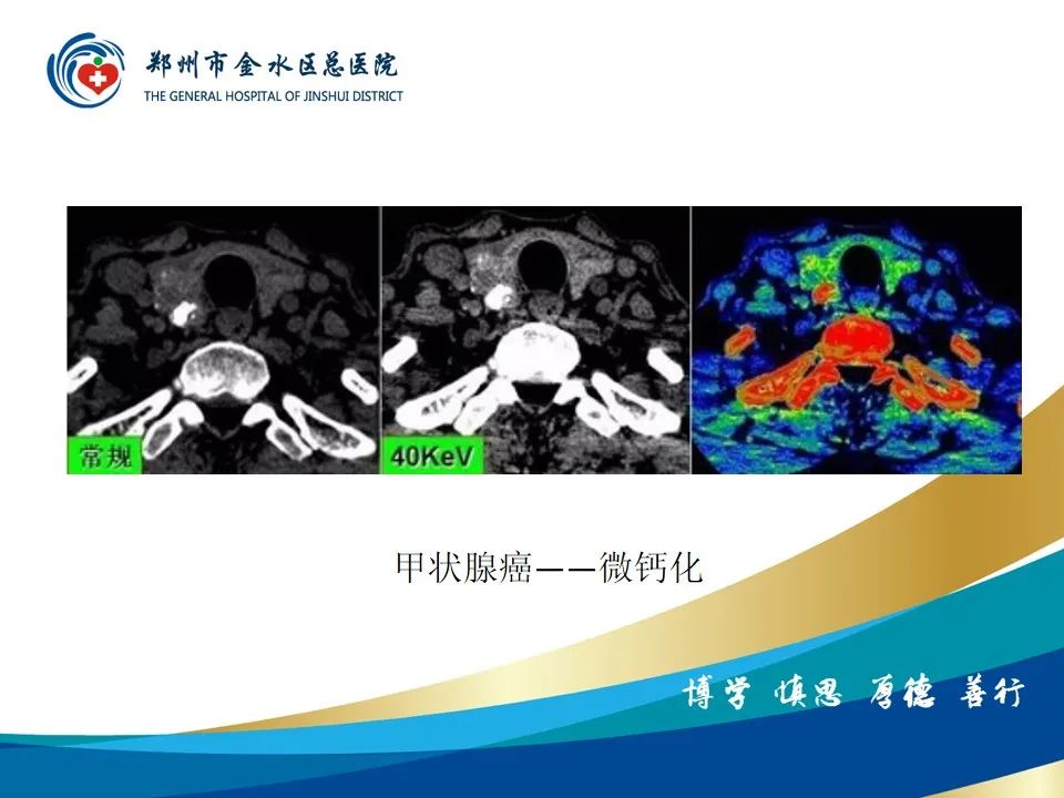 影像PPT - 【PPT】甲状腺常见相关疾病的影像诊断-35