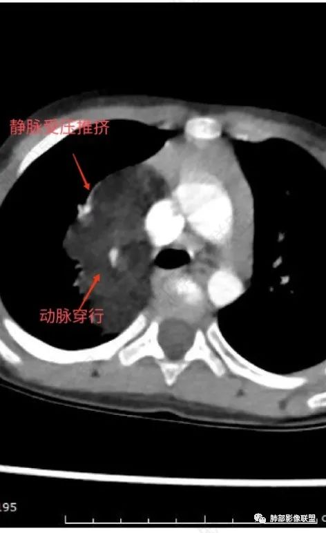 影像PPT - 【病例】幼儿脂肪母细胞瘤1例CT影像-45